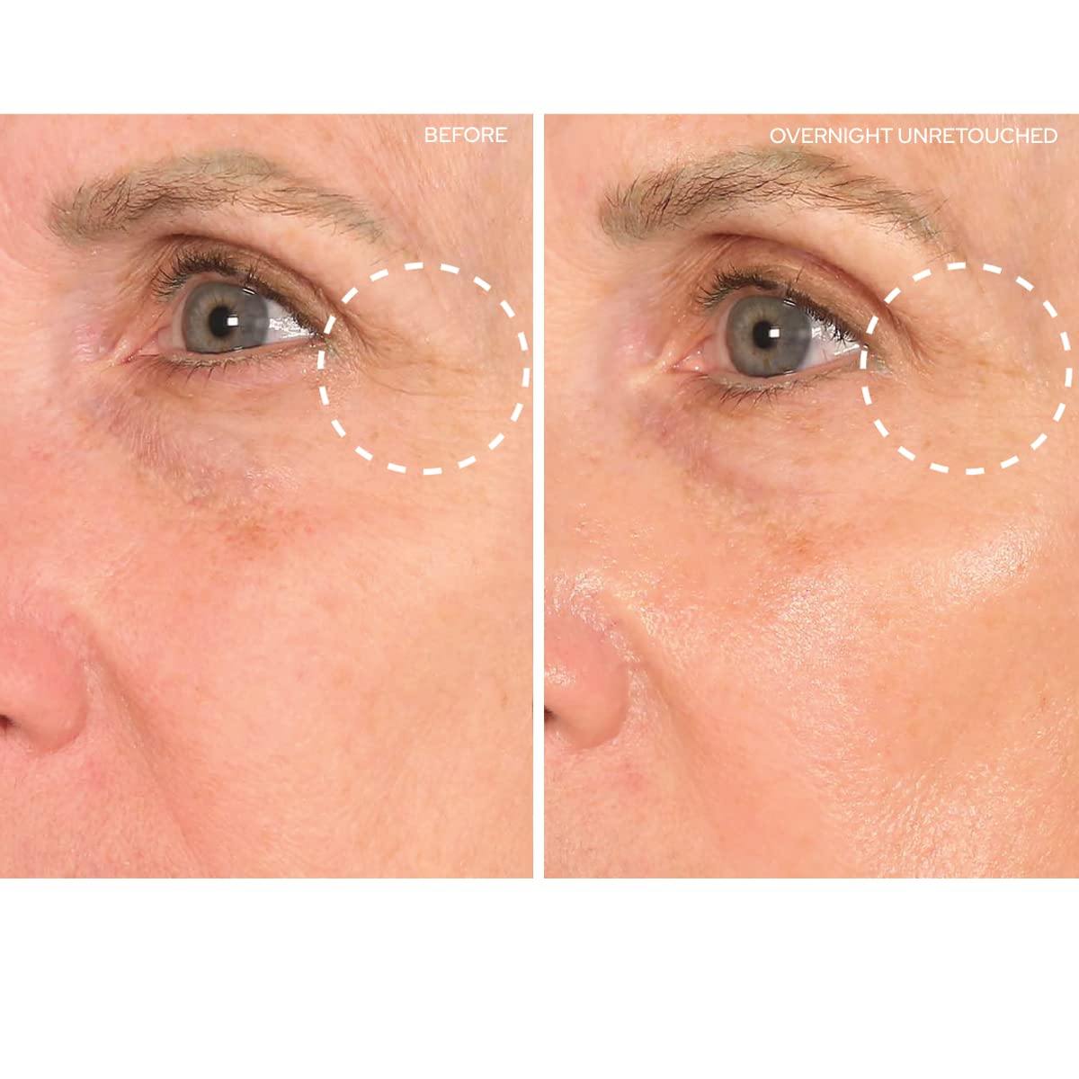 SiO Beauty Eye and Smile SuperLift - Eye & Lip Anti-Wrinkle Silicone Patches - Reduce Smile and Under Eye Wrinkles Overnight
