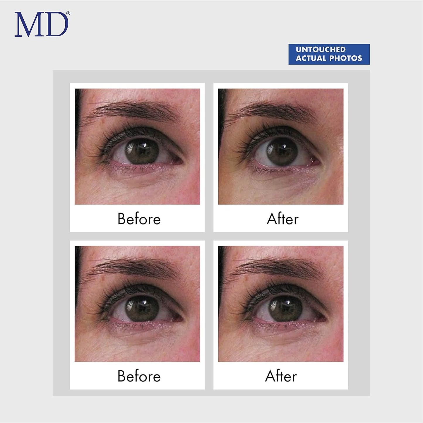 MD Ultimate Eye Cream – Under Eye Cream for Reduced Dark Circles, Puffiness, Wrinkles, Bags & Anti-Aging – Enriched with Collagen, Peptides, Shea Butter for Firmness, Lifting & Moisturization